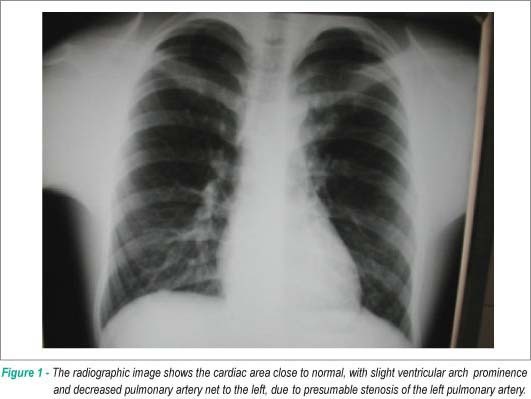 Case 4/2009: fourteen-year-old boy with atrial septal defect and left pulmonary artery stenosis