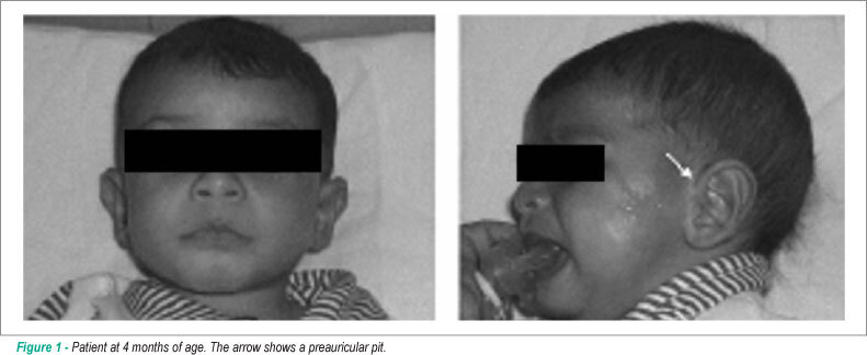Interrupted aortic arch type B in A patient with cat eye syndrome