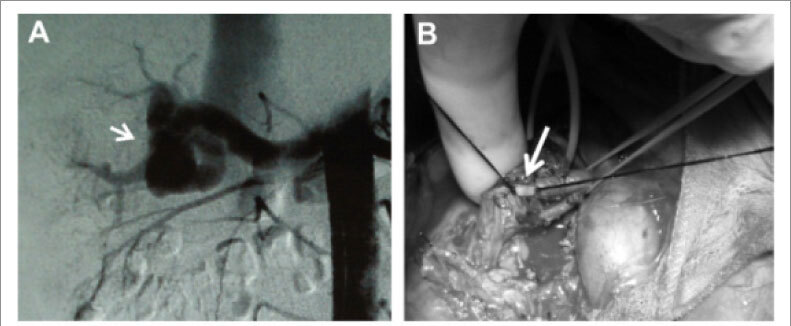 Three cases of hypertension and Renal Arteriovenous fistula with a de novo fistula