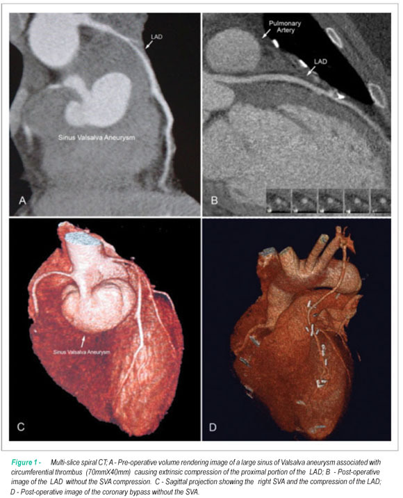 Right Sinus of Valsalva Aneurysm causing extrinsic coronary compression