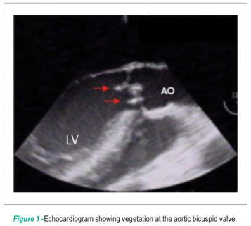 Infective endocarditis in aortic bicuspid valve and at aorta coarctation