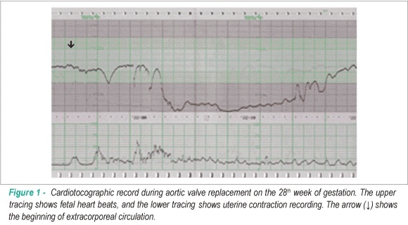 Maternal-fetal outcome and prognosis of cardiac surgery during pregnancy