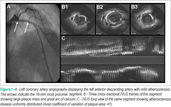 Subclinical coronary artery disease in patients with type 1 Diabetes Mellitus undergoing hemodialysis