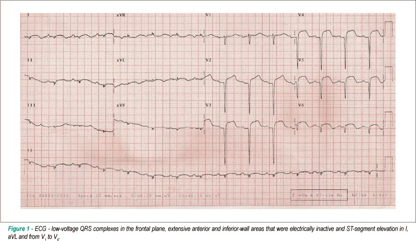 Case 3/2009: a 75 years old man with heart failure after myocardial infarction and ventricular aneurysm