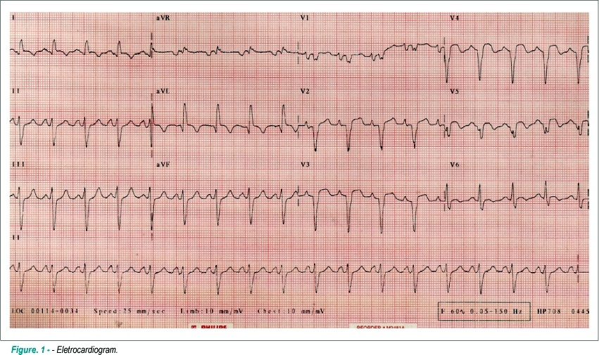 Myocardial infarction caused by coronary artery injury after a blunt chest trauma