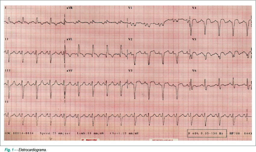 Infarto do miocárdio causado por lesão arterial coronariana após trauma torácico fechado