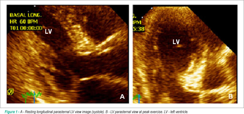 Dobutamine stress echocardiography-induced broken heart syndrome (Takotsubo Syndrome)