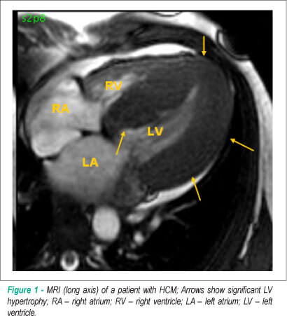Intraoperative transesophageal echocardiography in septal hypertrophic cardiomyopathy