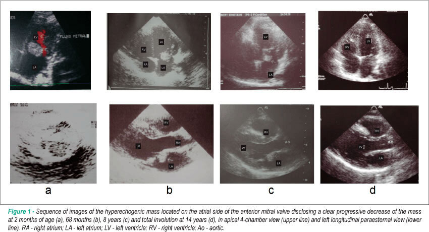 Late involution of obstructive rhabdomyoma of the mitral valve