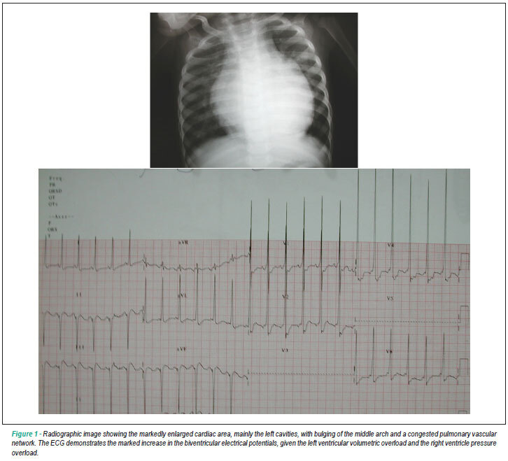Case 5/2009: eight-month old infant with mitral insufficiency due to hammock mitral valve with frank heart failure