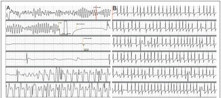Ventricular fibrillation during sport activity successfully treated