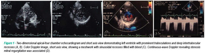 Echocardiographic features of non-compaction cardiomyopathy: missed and misdiagnosed disease