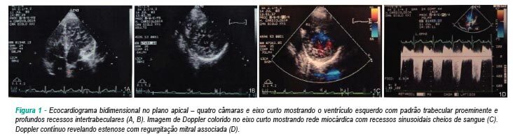 Características ecocardiográficas da cardiomiopatia não-compactada: diagnóstico perdido ou errôneo