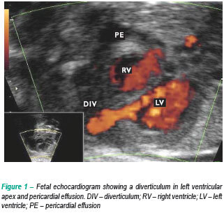 Prenatal diagnosis of left ventricular aneurysm and diverticulum