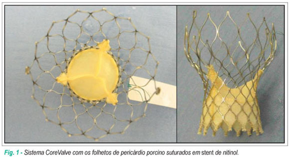 Substituição valvar aórtica percutânea para o tratamento da estenose aórtica: experiência inicial no Brasil