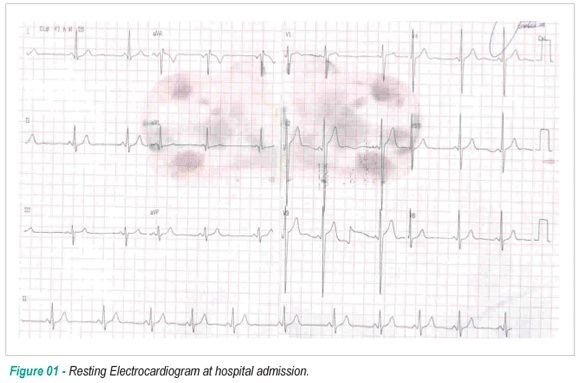 Occlusion of the left coronary trunk secondary to tertiary syphilis