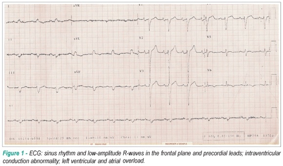 Case 4/2009: a 55-year-old male patient with Chagas cardiomyopathy who developed progressive worsening of dyspnea, chest pain and pulmonary interstitial infiltrate