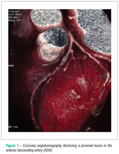 Coronary artery bypass using only computed tomography as pre-operative angiogram