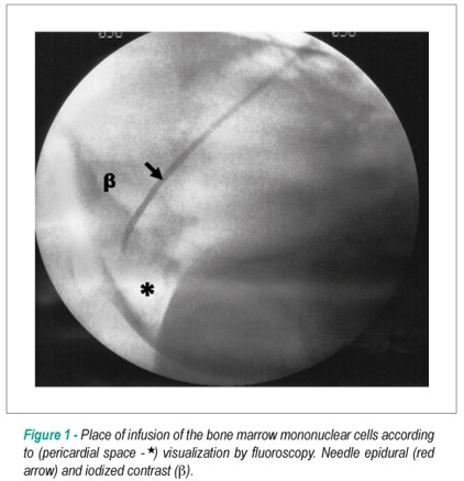 Myocardial homing after intrapericardial infusion of Bone Marrow Mononuclear Cells