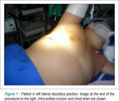 Videothoracoscopy for isolated atrial fibrillation ablation through bipolar radiofrequency