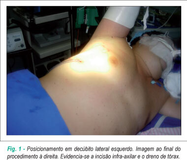 Cirurgia vídeo-assistida para a ablação da fibrilação atrial isolada por radiofrequência bipolar