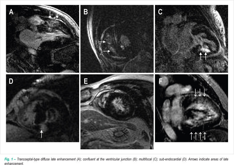 Late enhancement and myocardial perfusion in hypertrophic cardiomyopathy (comparison betw een groups)