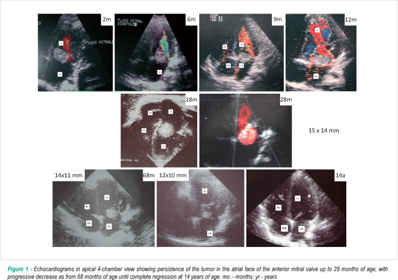 Late spontaneous regression of obstructive tumor in the mitral valve