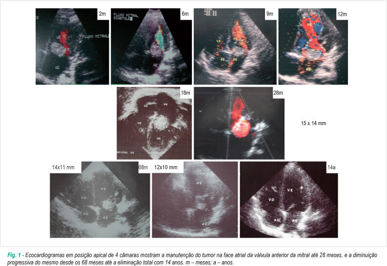 Regressão tardia espontânea de tumor obstrutivo na valva mitral