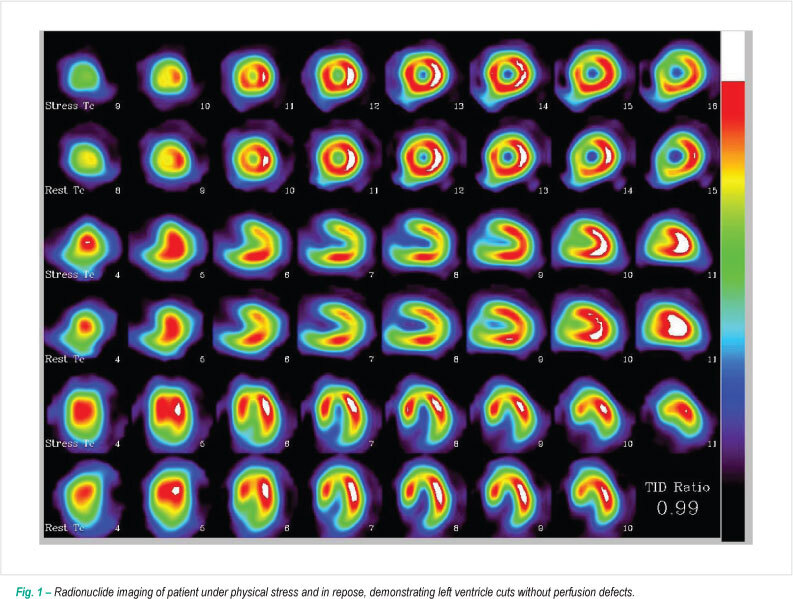 Radionuclide imaging of myocardium with mental stress in the investigation of thoracic pain