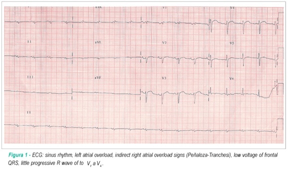 Case 5: 50-year-old woman with restrictive cardiomyopathy, renal failure and proteinuria