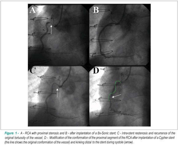 Late restenosis related to Cypher stent fracture