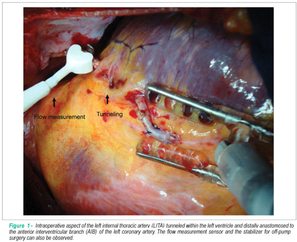 Modification of an old procedure (Vineberg) in the stem cell era: a new strategy?