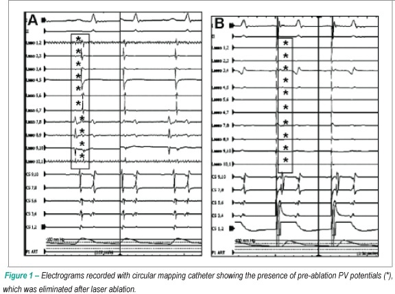 Utility of intracardiac ultrasound imaging to guide pulmonary vein ablation using laser balloon catheter