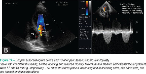 Aortic valvuloplasty with balloon catheter in maternal-fetal emergency in adolescence