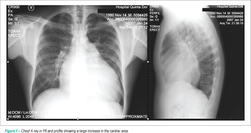 Refractory heart failure in a patient with non-compacted myocardium