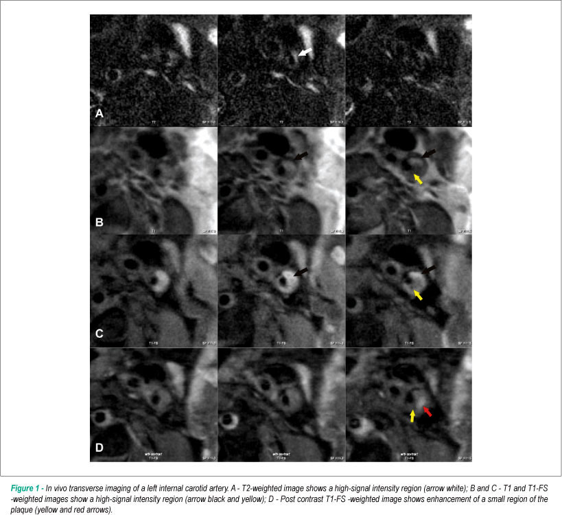 18F-FDG in distinction of atherosclerotic plaque: Innovation in PET/MRI technology