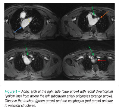 Atypical presentation of Kommerell's diverticulum