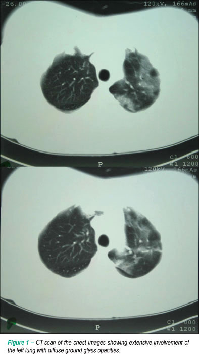 Influenza A (H1N1) pneumonia in an immunossupressed patient after heart transplantation