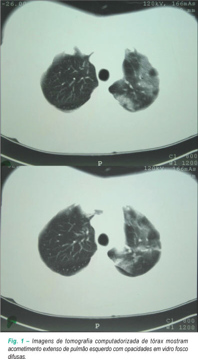 Pneumonia por Influenza A(H1N1) em paciente imunossuprimido após transplante cardíaco