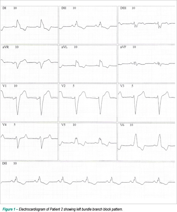 Chronic chagasic cardiopathy in Amazon region: an etiology to remember