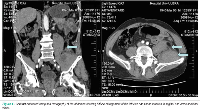 Iliopsoas muscle hematoma during treatment with warfarin