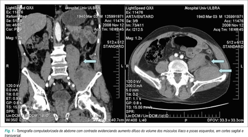 Hematoma de músculo iliopsoas na vigência de tratamento com varfarina