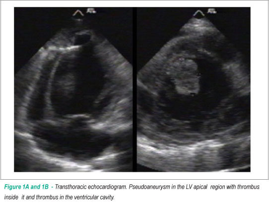 Chronic left ventricular pseudoaneurism of undetermined etiology