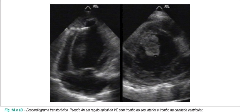 Pseudoaneurisma crônico do ventrículo esquerdo de etiologia indeterminada