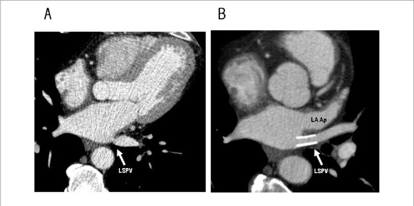 Treatment of pulmonary vein stenosis after percutaneous ablation of atrial fibrillation