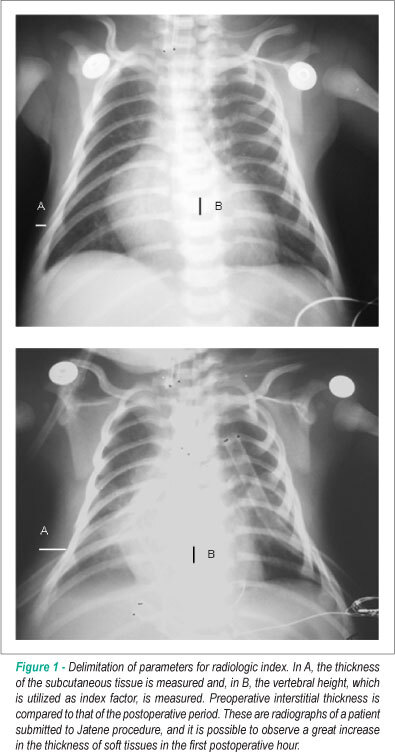 Clinical profile of systemic inflammatory response after pediatric cardiac surgery with cardiopulmonary bypass