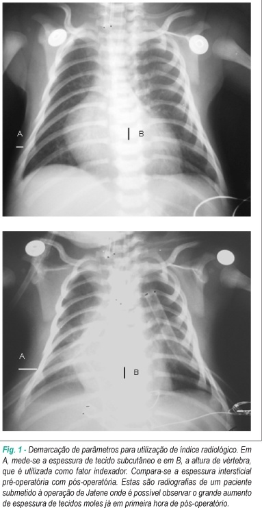 Perfil clínico da resposta inflamatória sistêmica após cirurgia cardíaca pediátrica com circulação extracorpórea