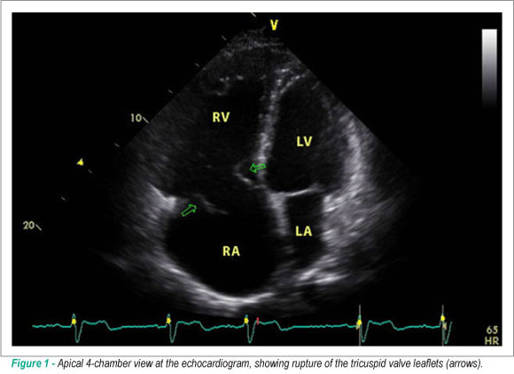Tricuspid valve lesion due to penetrating chest trauma