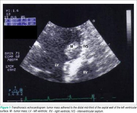 Left ventricular papillary fibroelastoma