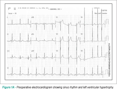 Acute coronary artery dissection after aortic valve replacement
